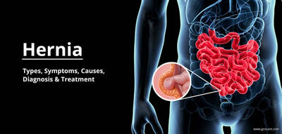 Hernia: Types, Symptoms, Causes, Diagnosis & Treatment