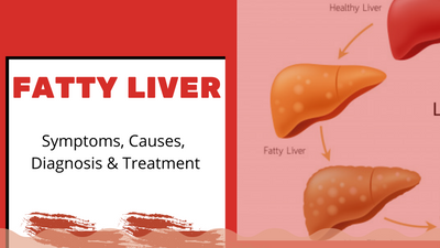 Fatty Liver Disease: Causes, Symptoms, Diagnosis & Treatment
