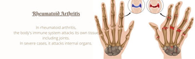 Home Remedies For Rheumatoid Arthritis: Symptoms, Causes and Treatment