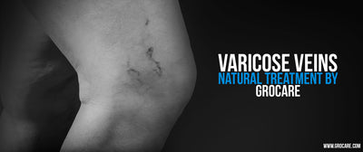 How to Treat Varicose Veins Naturally, Without Surgery